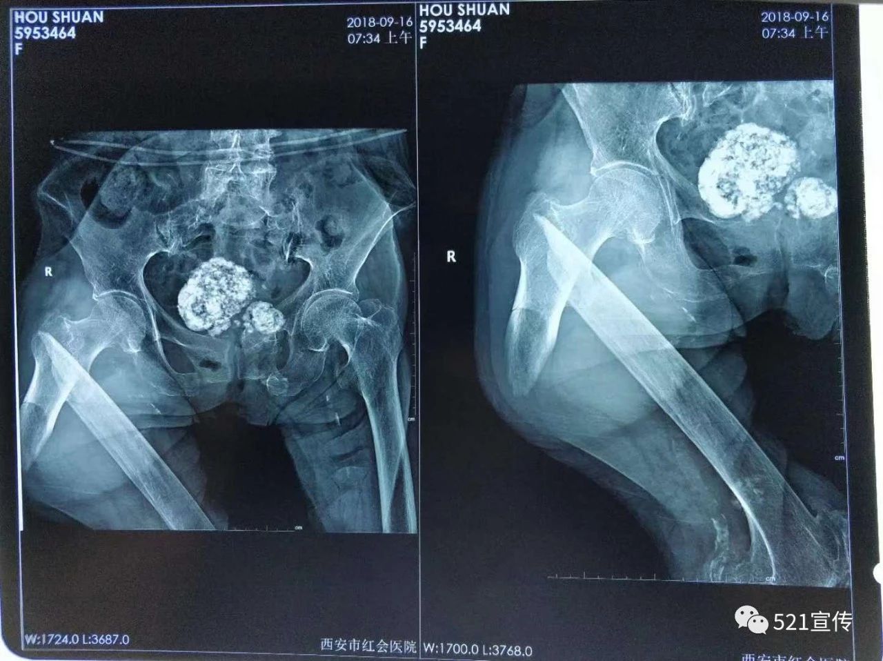 （术后）